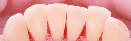 Professional oral hygiene
