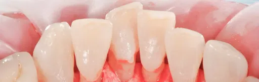 Professional oral hygiene