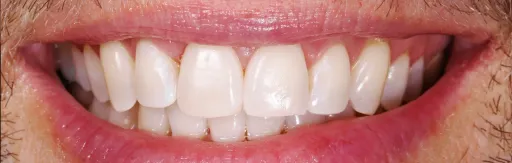 White teeth whitening zoom4