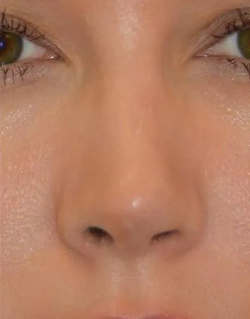 Rhinoplasty