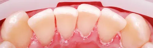Professional oral hygiene