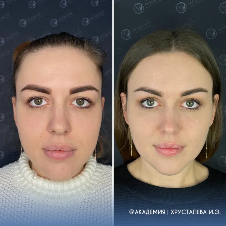 Face beatification The photos were taken before and 5 months after the operation. Anastasia is 25 years old. She made the following complaints: pronounced furrows on the lower eyelids, excessive thickness of the cheeks, pubescent tails of the eyebrows and