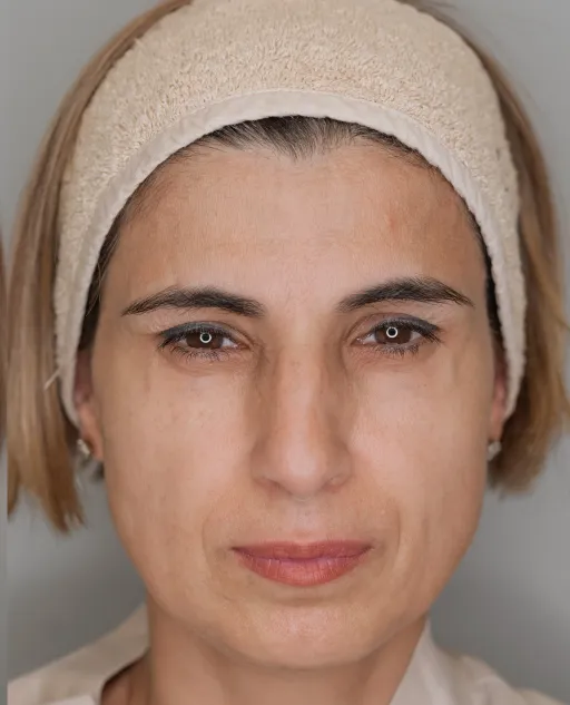 Botulin therapy
