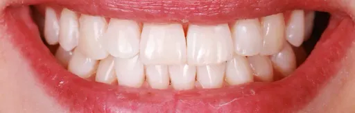 White teeth whitening zoom4