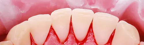 Professional oral hygiene