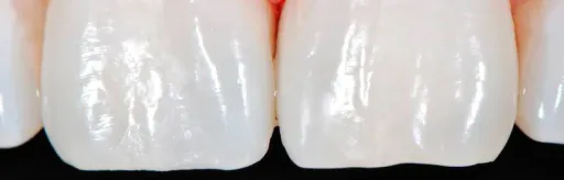 White teeth whitening zoom4