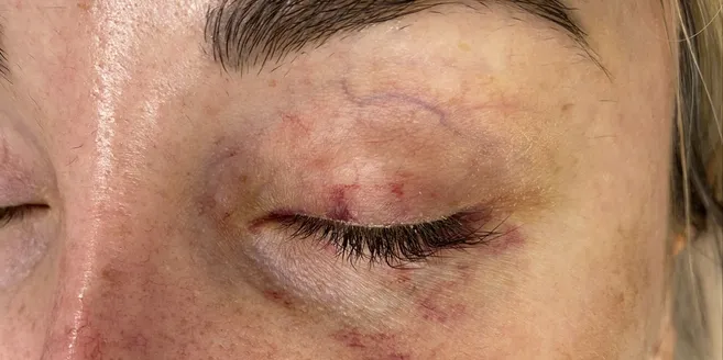 Treatment of vascular defects on the face