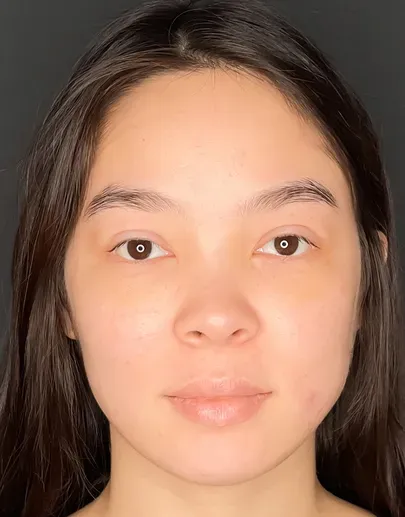 Blefaroplasty