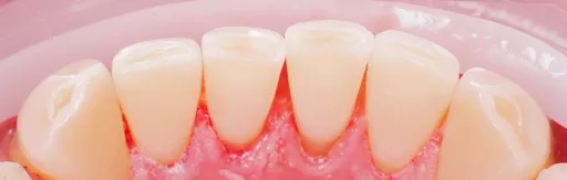 Professional oral hygiene