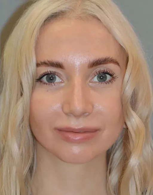 Rhinoplasty