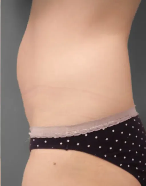 Cryomothydration of the COOLTECH COCOON MEDICAL device (Cryolipolysis)