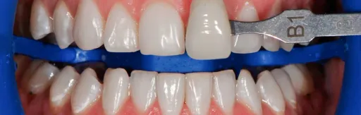 White teeth whitening zoom4
