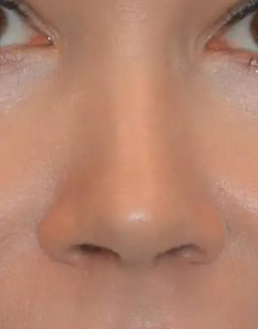 Rhinoplasty