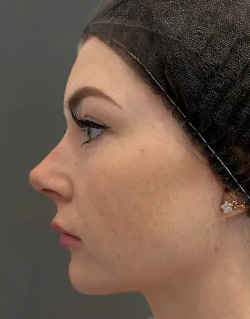 Skin Tyte infrared thermolift