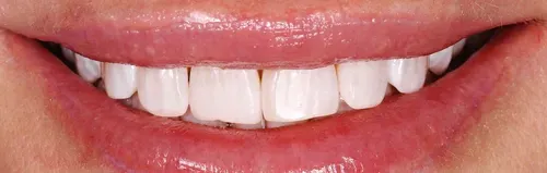 White teeth whitening zoom4