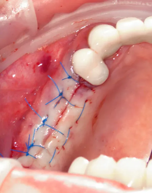 Simultaneous implantation