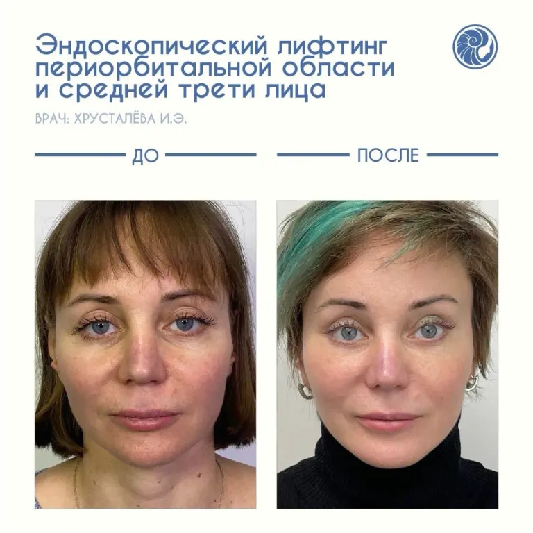 The result of complex rejuvenating and harmonizing facial surgery🔝 The photos were taken before and 1 year after the operation.