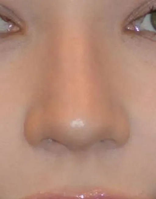 Rhinoplasty
