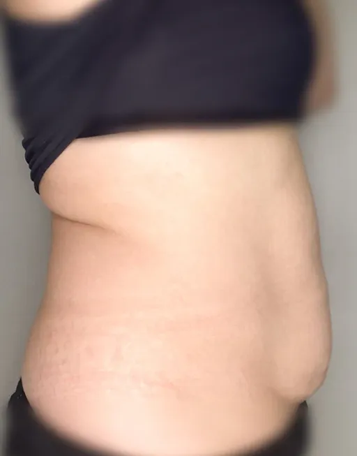 Cryomothydration of the COOLTECH COCOON MEDICAL device (Cryolipolysis)