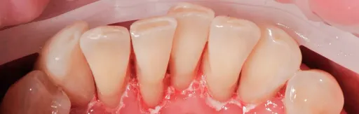 Professional oral hygiene