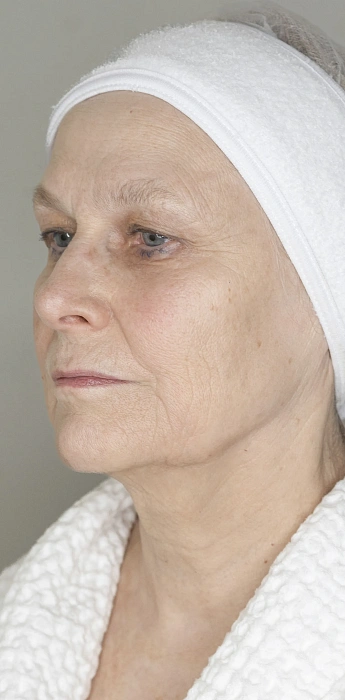 7D-rejuvenation Thermolifting Oligio