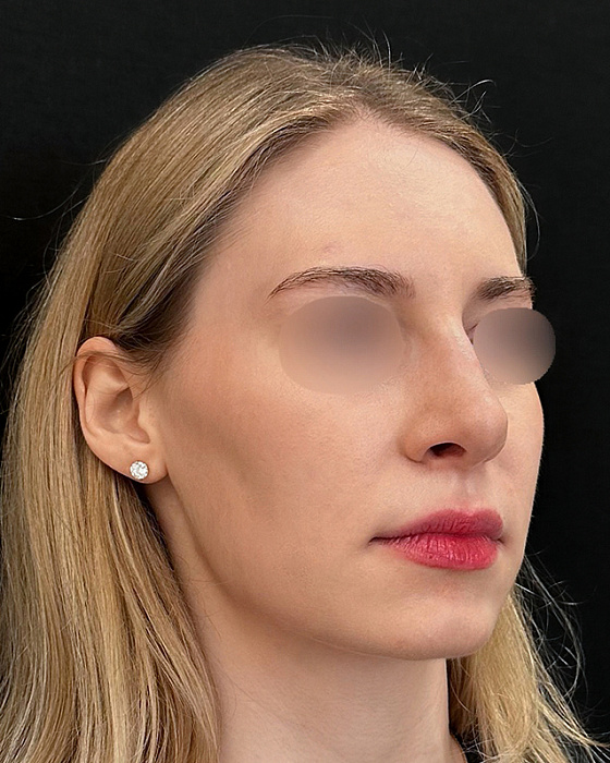 Rhinoseptoplasty