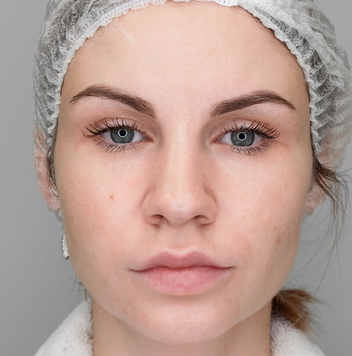 Treatment of pigmented disorders Candela