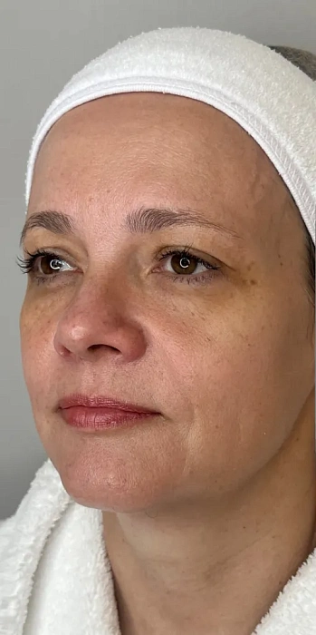 7D-rejuvenation Thermolifting Oligio