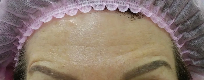 Botulin therapy