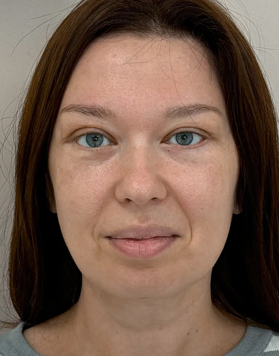 Blefaroplasty