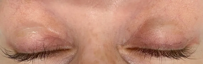 Treatment of skin defects VBEAM