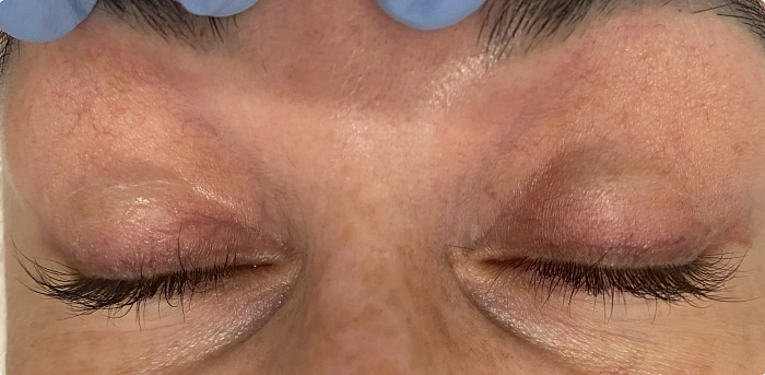 Treatment of vascular defects on the face