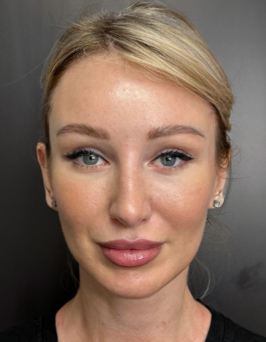 Endoscopic forehead lift