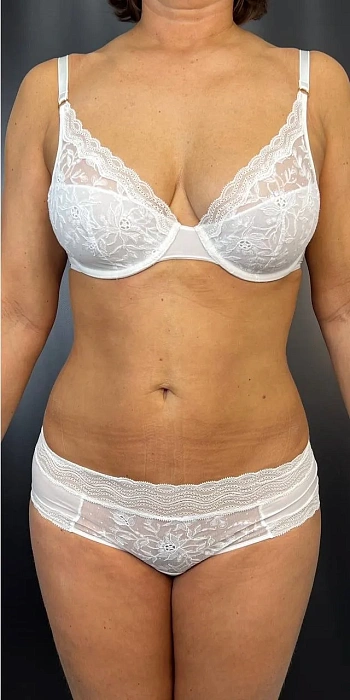 Liposculpture