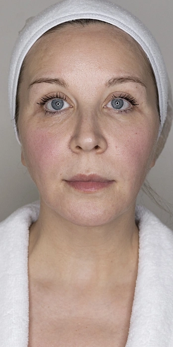 7D-rejuvenation Thermolifting Oligio