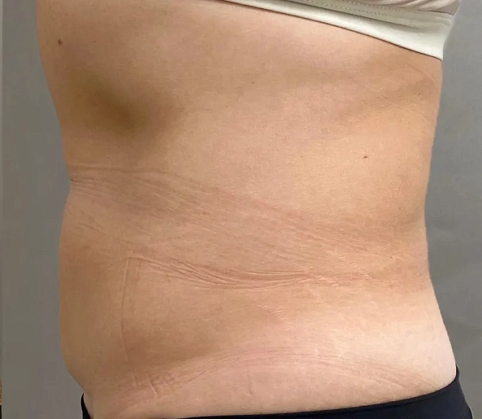 Cryomothydration of the COOLTECH COCOON MEDICAL device (Cryolipolysis)