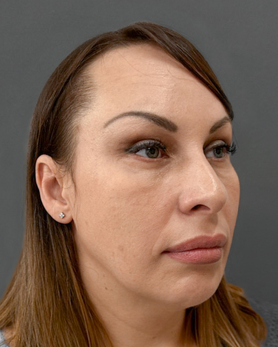 Endoscopic forehead lift, Periorbitoplasty