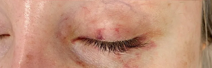 Treatment of skin defects VBEAM