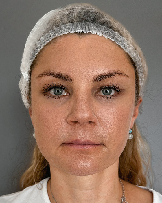  Blefaroplasty, Endoscopic forehead lift, Lower blepharoplasty, Upper blepharoplasty