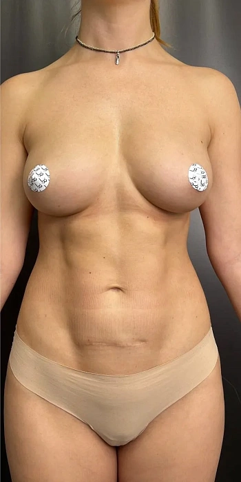 Lipofilling