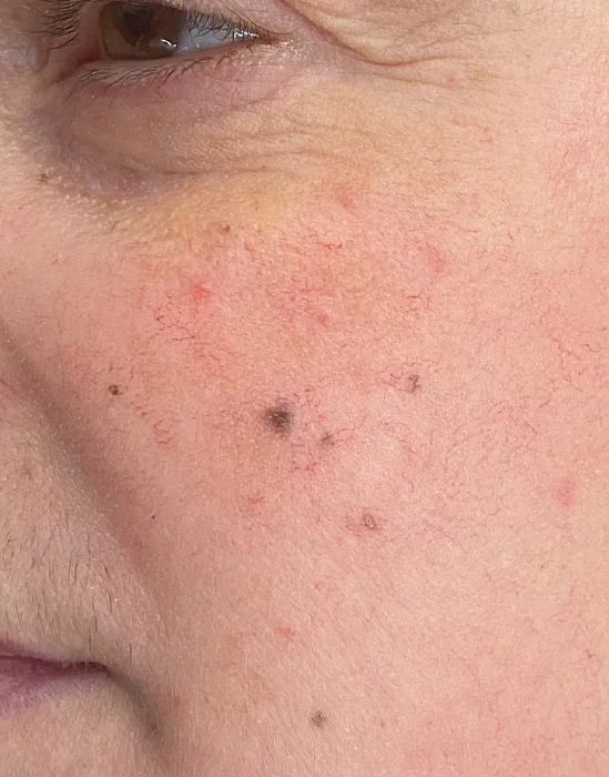 Treatment of skin defects VBEAM