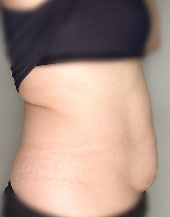Treatment of skin defects VBEAM