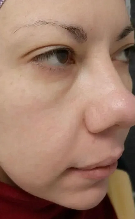 Program for grinding stretch marks, scars and post -acne