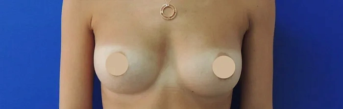 Breast reduction