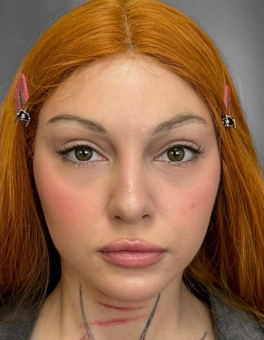 Blefaroplasty