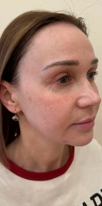 7D-rejuvenation Thermolifting Oligio