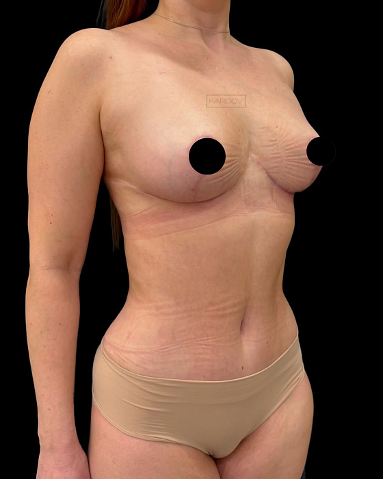 Breast lift with reduction, Abdominoplasty with diastasis suturing, Liposculpture
