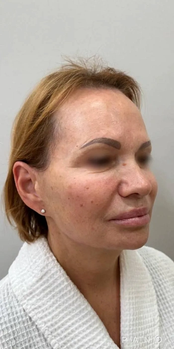 Contouring of the face with Radiesse filler