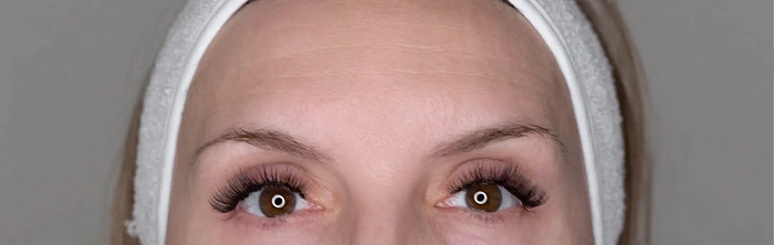 Botulin therapy
