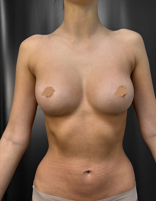 Lipofilling